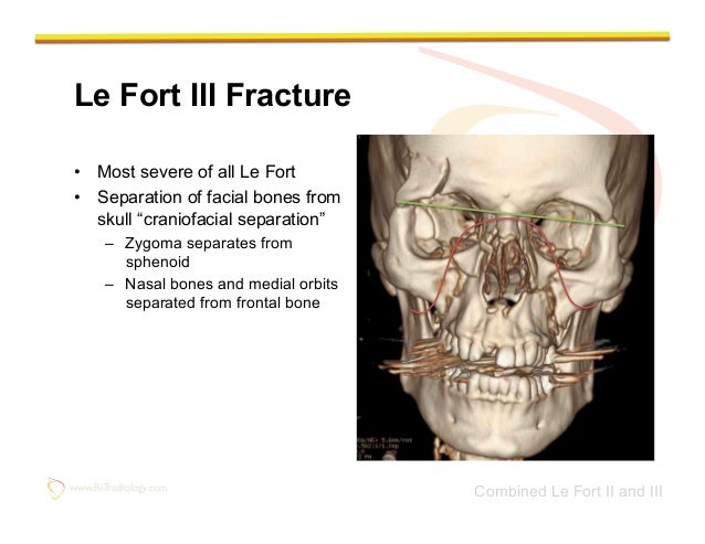 facial fracture slideshows Tv show the unit nude pics